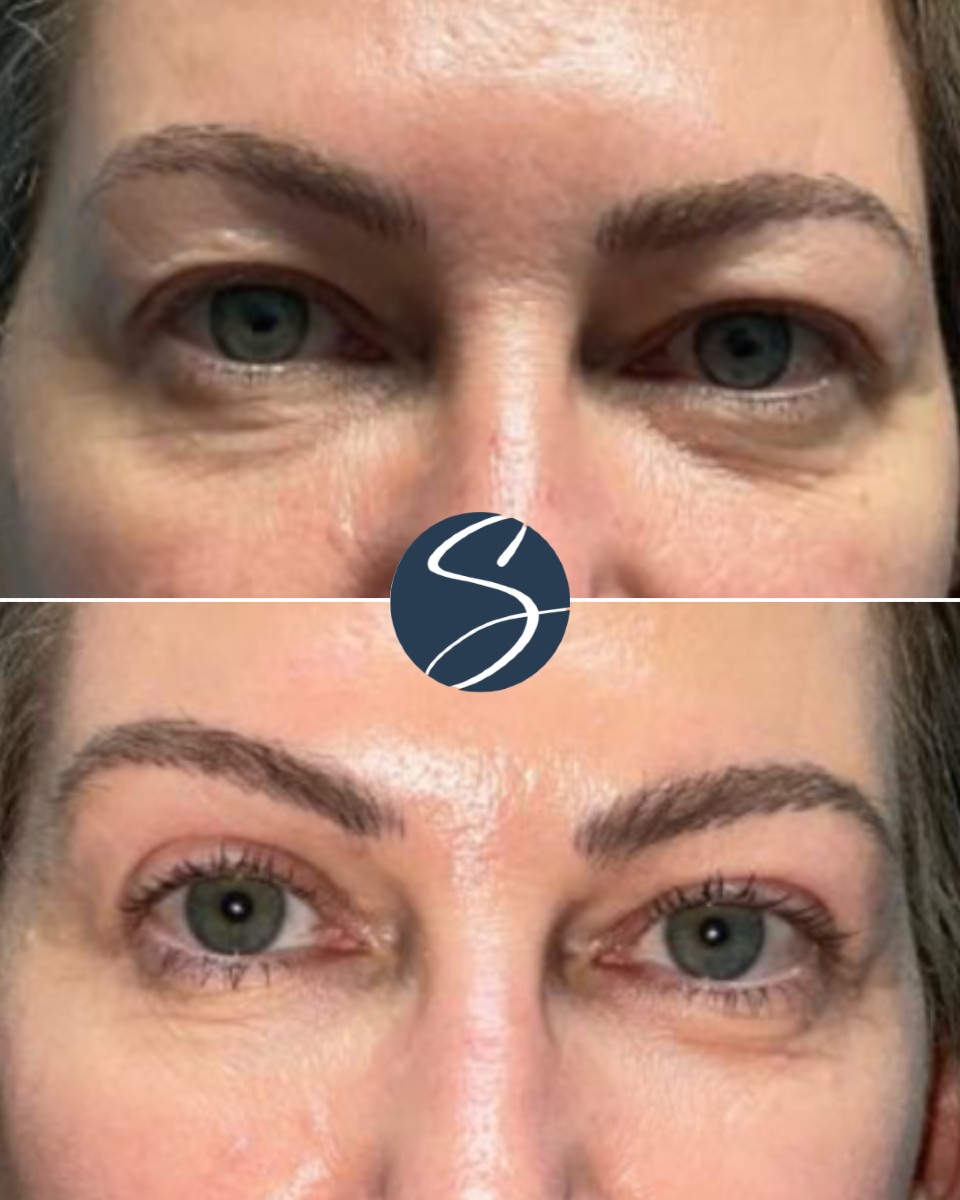 Instagram post by Dr. J. Anthony Stephens: TIRED OF LOOKING TIRED? 😴 No amount of caffeine can do what #EyelidSurgery can do, y'all. 🙌 Also known as #Blepharoplasty, this procedure …