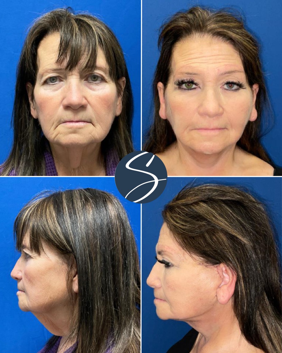Instagram post by Dr. J. Anthony Stephens: ENHANCING WHILE UNDER. 😴 Did you know Dr. Stephens can combine multiple procedures in one #CosmeticSurgery — including CO2 Laser Resurfacin…