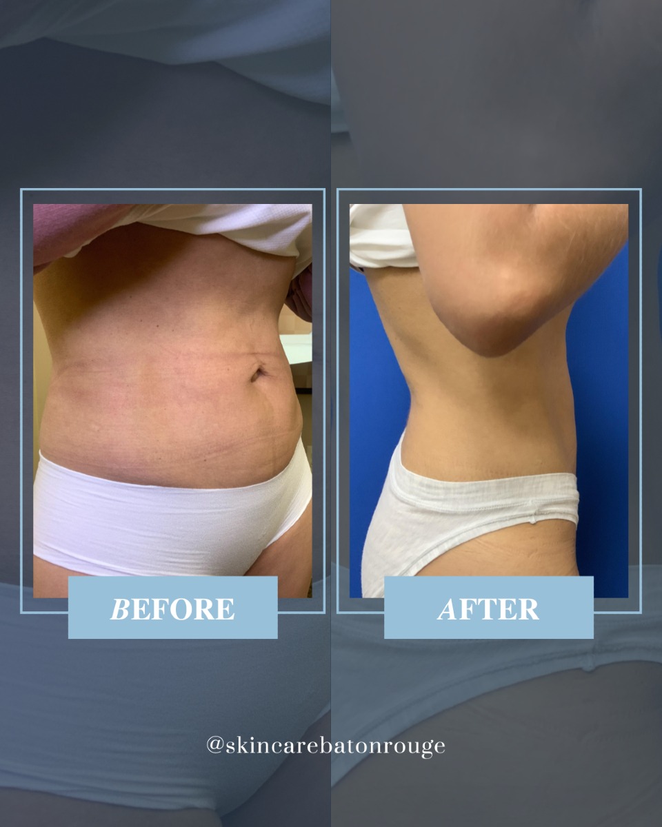 Instagram post by Dr. J. Anthony Stephens: That CoolSculpting® MAGIC. 🪄 #CoolSculpting is the #1 non-invasive fat reduction treatment in the world — and with results like these, it i…