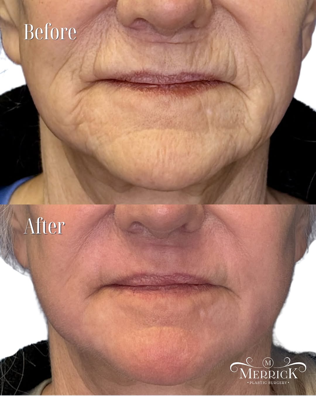 Instagram post by Dr. J. Clinton Merrick: Perioral deep laser resurfacing is one of the most effective treatments for stubborn lines and wrinkles around the mouth. This procedure rem…