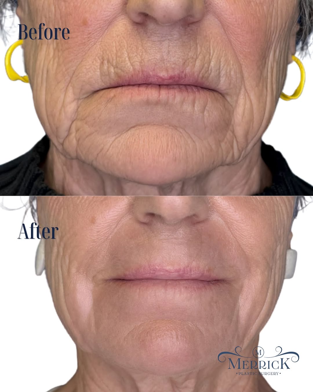 Instagram post by Dr. J. Clinton Merrick: Deep laser resurfacing around the mouth is designed to smooth stubborn lines and wrinkles where fillers and injectables often fall short. By…