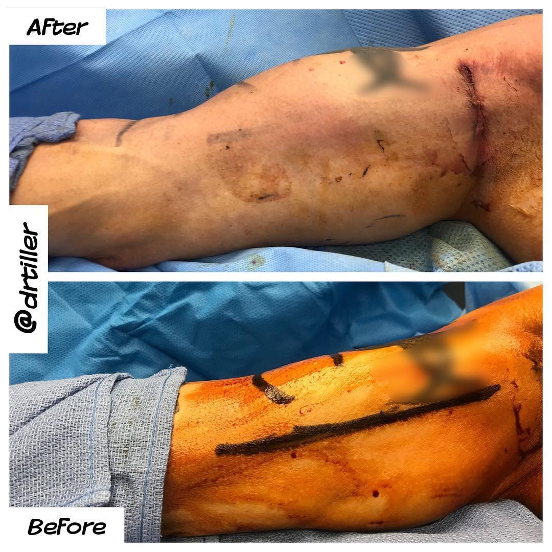 Instagram post by Dr. J. Howell Tiller: Bicep tears in men can cause a disfiguring appearane of the upper arm even after orthopedic repair. A properly-sized and placed implant can …