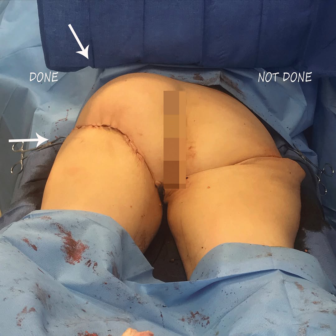 Instagram post by Dr. J. Howell Tiller: After extensive weight loss a circumferential thigh lift including buttock implants can dramatically smoothen and tighten thigh skin and but…