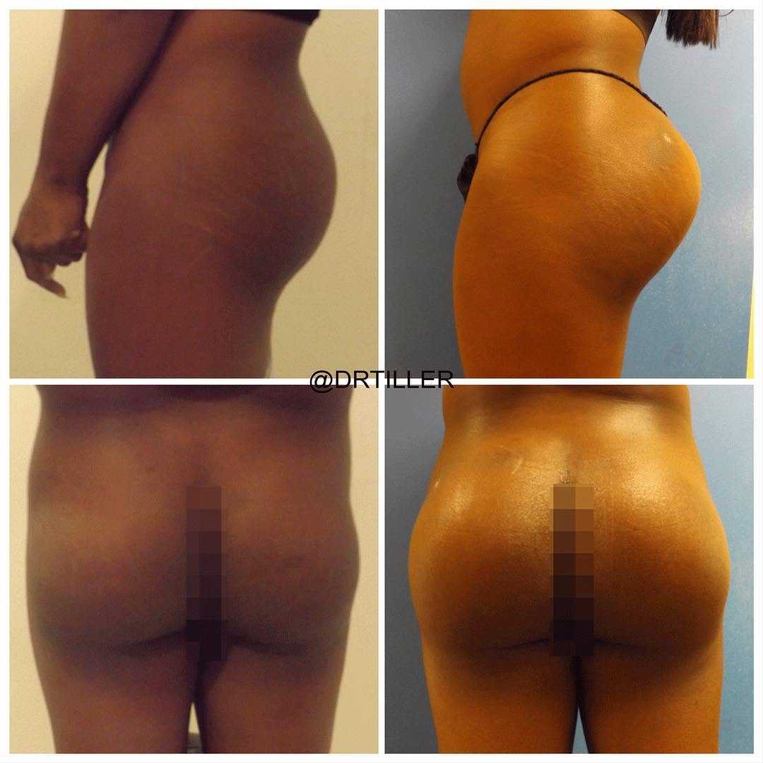 Instagram post by Dr. J. Howell Tiller: As effective as fat transfer to the buttocks (Brazilian Butt Lift) is for enlarging and contouring the buttock area, many patients just don'…