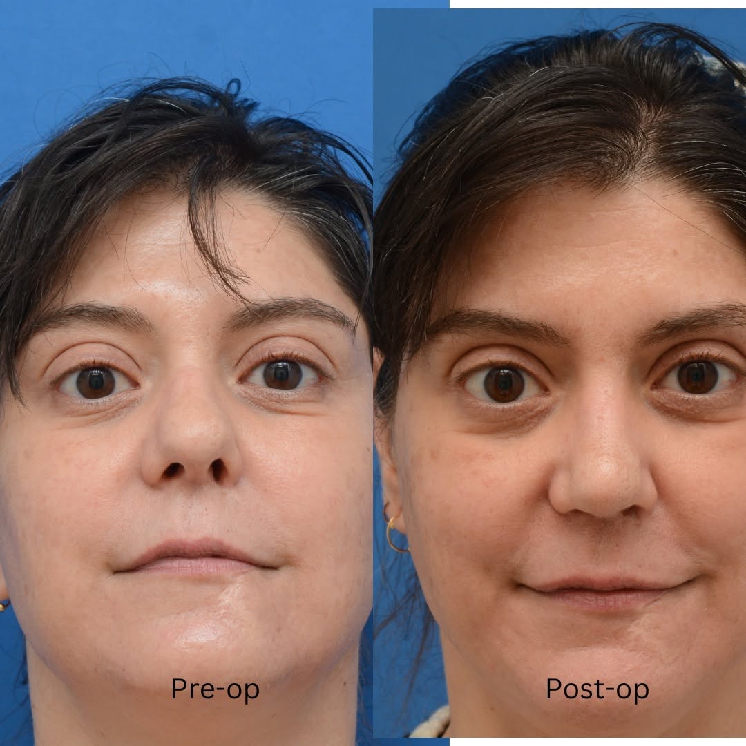 Instagram post by Dr. J. Jared Christophel: This delightful patient suffered a bad bike wreck many years ago and then had a reconstructive surgery that unfortunately left her nose shor…