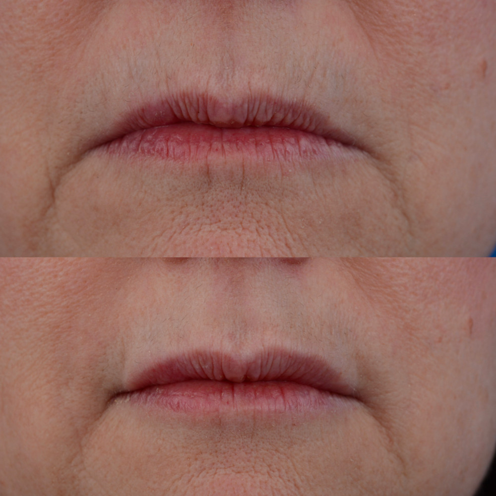 Instagram post by Dr. J. Jared Christophel: What can I expect while recovering from getting lip fillers? The procedure typically takes between 30 minutes and two hours. Upon completion…