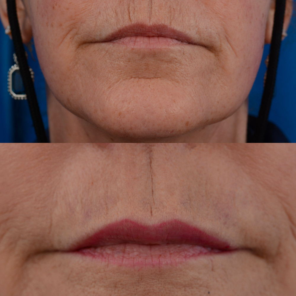 Instagram post by Dr. J. Jared Christophel: Restoring previous lip size, reducing wrinkles and changing the shape of your lips are all potential reasons to receive lip fillers. While t…