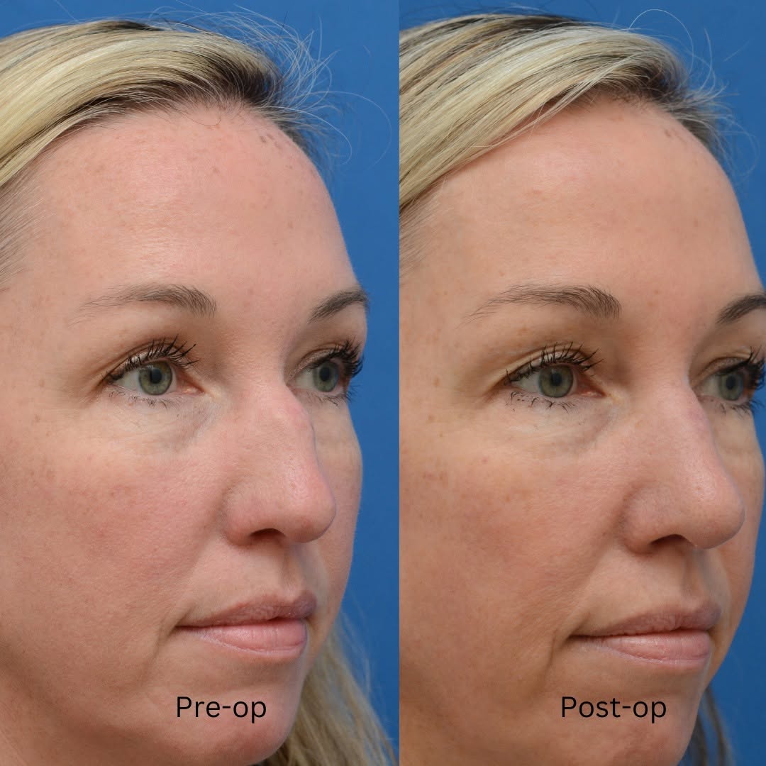 Instagram post by Dr. J. Jared Christophel: Restoration rhinoplasty. Patient had prior skin cancer reconstruction over bridge of nose that exacerbated some underlying asymmetry. We set…