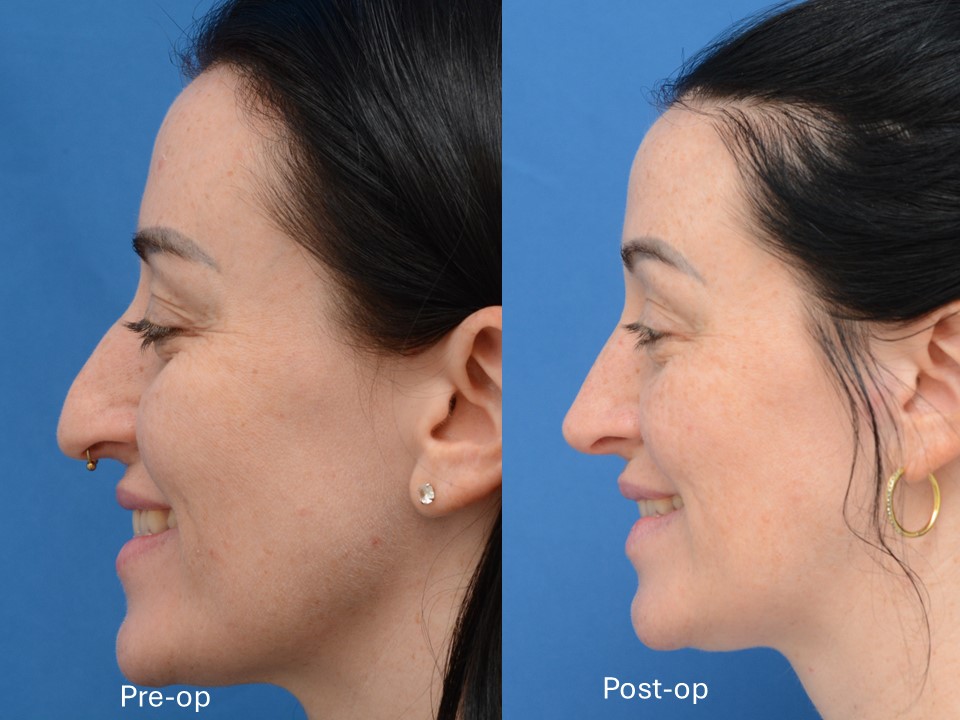 Instagram post by Dr. J. Jared Christophel: One year post op from from surgery to improve nasal airway obstruction, and toss in a little hump reduction and tip elevation at the end. #r…