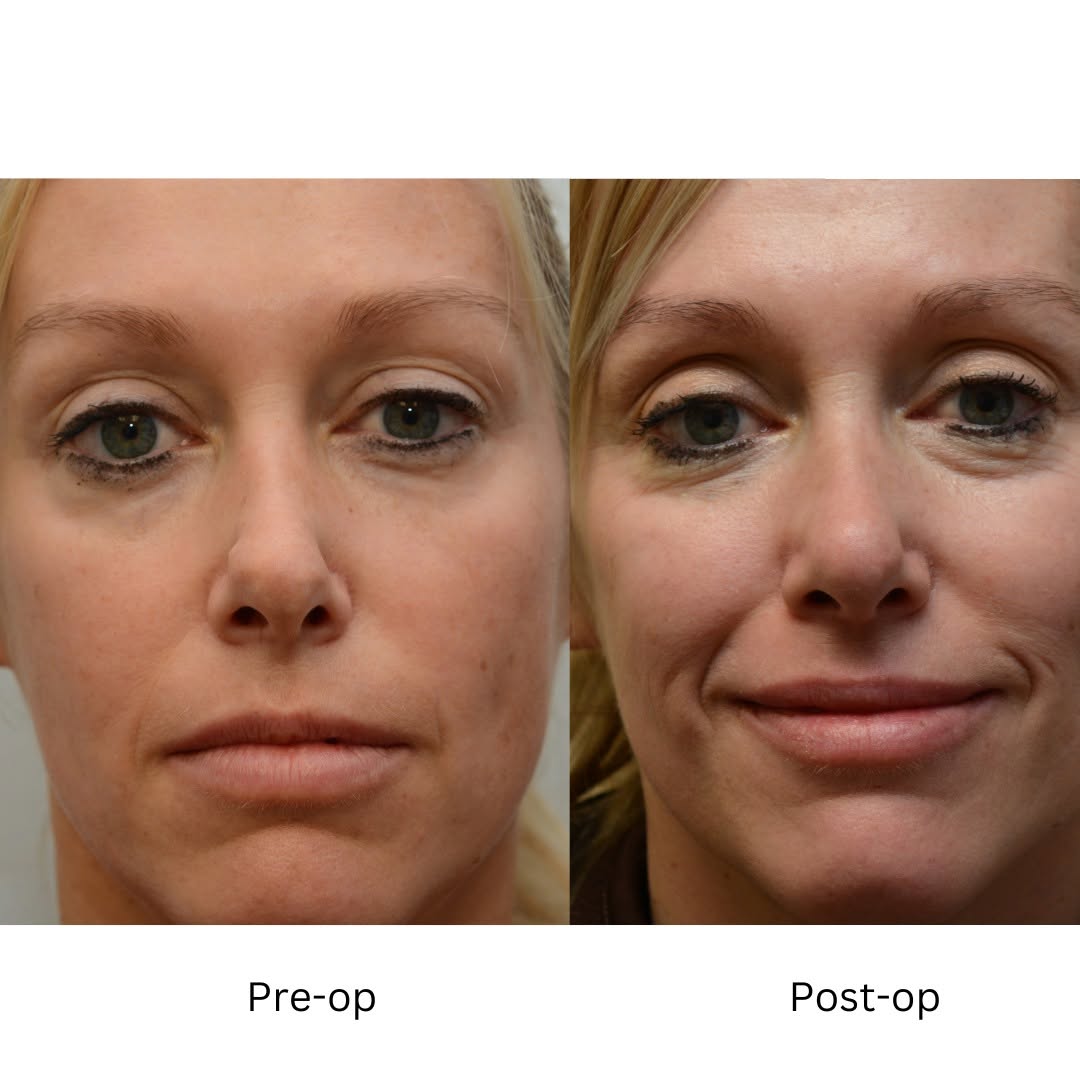 Instagram post by Dr. J. Jared Christophel: Sometimes the minor changes can be the tough ones. Lovely patient had a history of a reductive endonasal rhinoplasty 15 years ago. The lower…