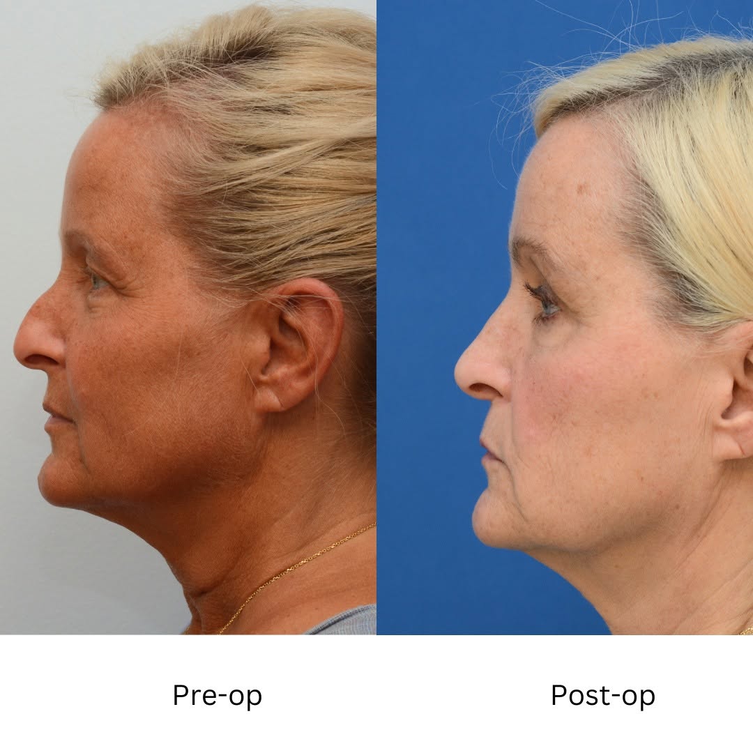 Instagram post by Dr. J. Jared Christophel: Lovely patient came back to see me for another reason 4 years after her rhinoplasty. Kindly allowed me to use her photos. I continue to be i…