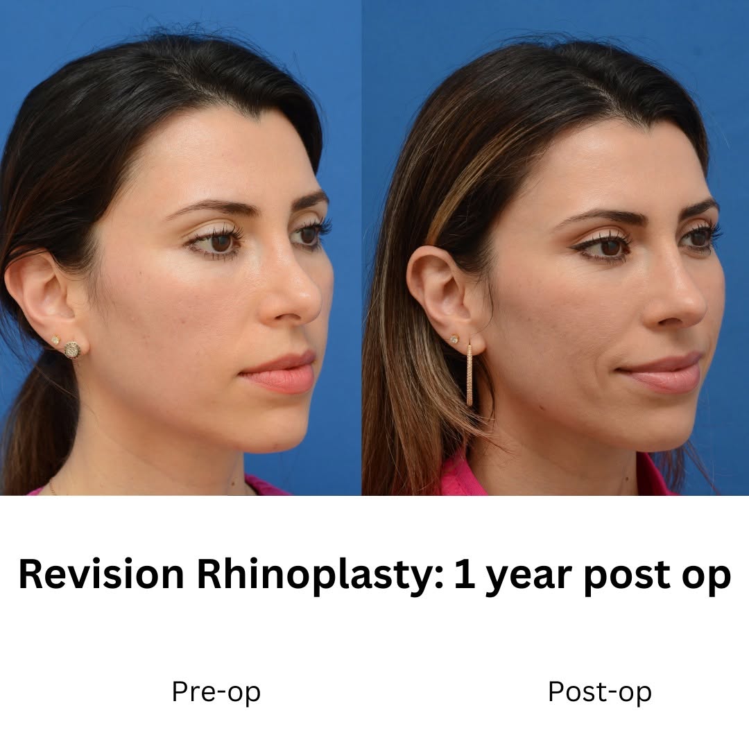 Instagram post by Dr. J. Jared Christophel: I usually expect to use rib in these cases, but her previous surgery only used an endonasal approach for dorsal resection and large cephalic…