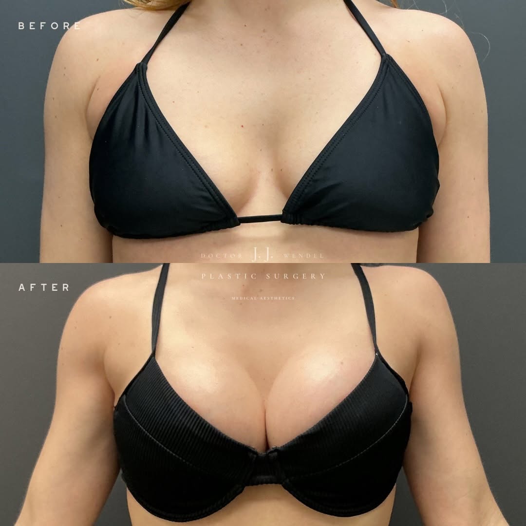 Instagram post by Dr. J. Jason Wendel: 8 MONTHS POST-OP ✔️ This patient underwent a breast augmentation by Dr. Jason Wendel with @natrellebreastaugmentation SCX 650 cc implants an…