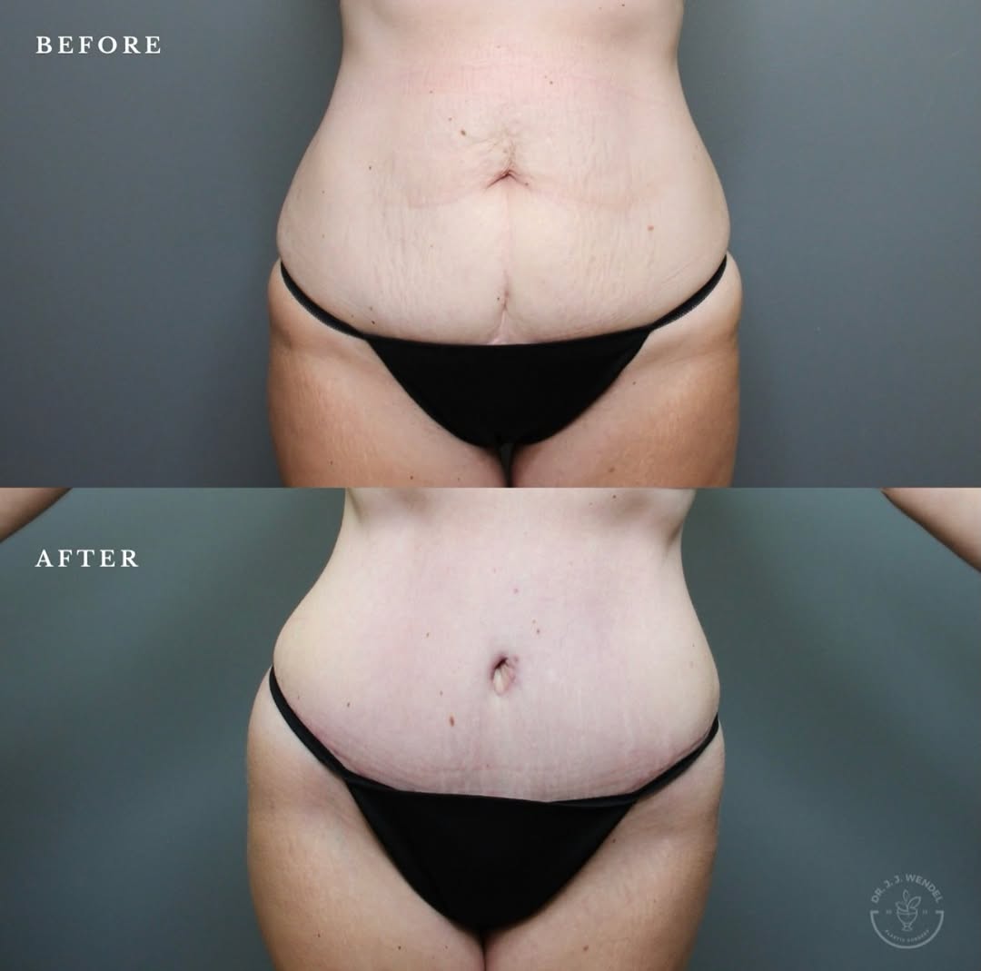 Instagram post by Dr. J. Jason Wendel: BEFORE & AFTER: Tummy Tuck 📋 An abdominoplasty (tummy tuck) is designed to remove excess skin, tighten the abdominal muscles, and create a …