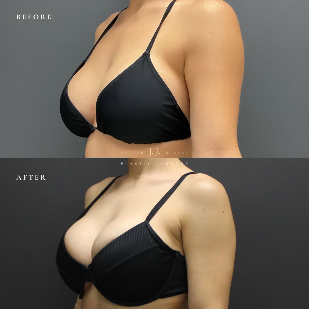 Instagram post by Dr. J. Jason Wendel: More volume. Better shape. Elevated outcome. This patient came to us ready for a change—wanting fuller implants with a lifted, more refined …