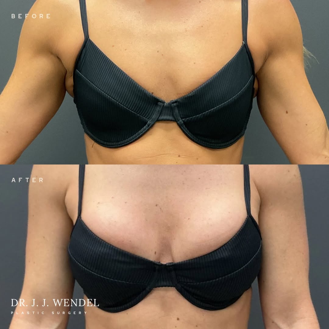 Instagram post by Dr. J. Jason Wendel: Breast Augmentation Results This patient is shown before and after breast augmentation with 365cc Natrelle implants performed by Dr. Jason W…