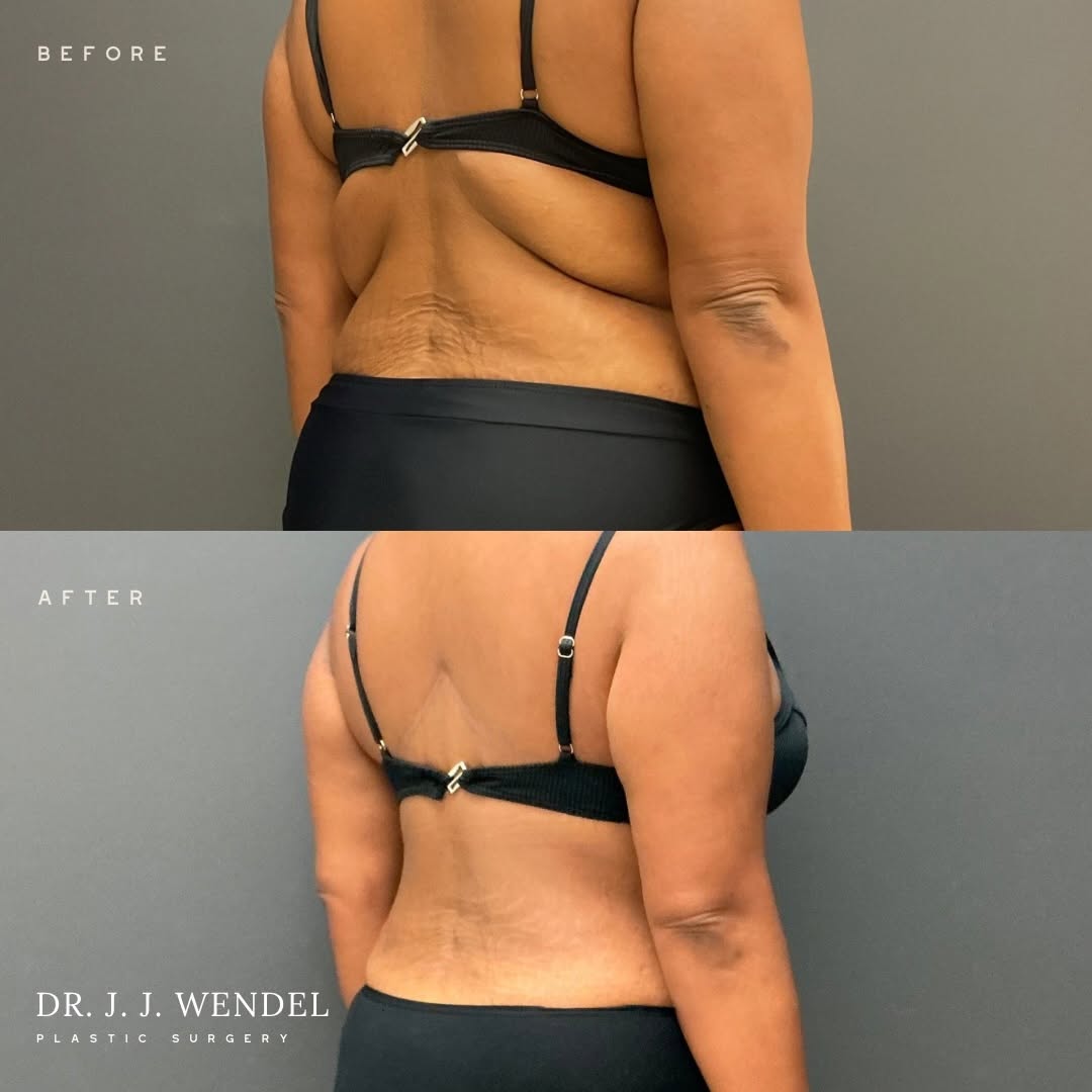 Instagram post by Dr. J. Jason Wendel: Before & After: Upper Back Lift An upper back lift is a body contouring procedure designed to remove excess skin and reshape the upper torso…