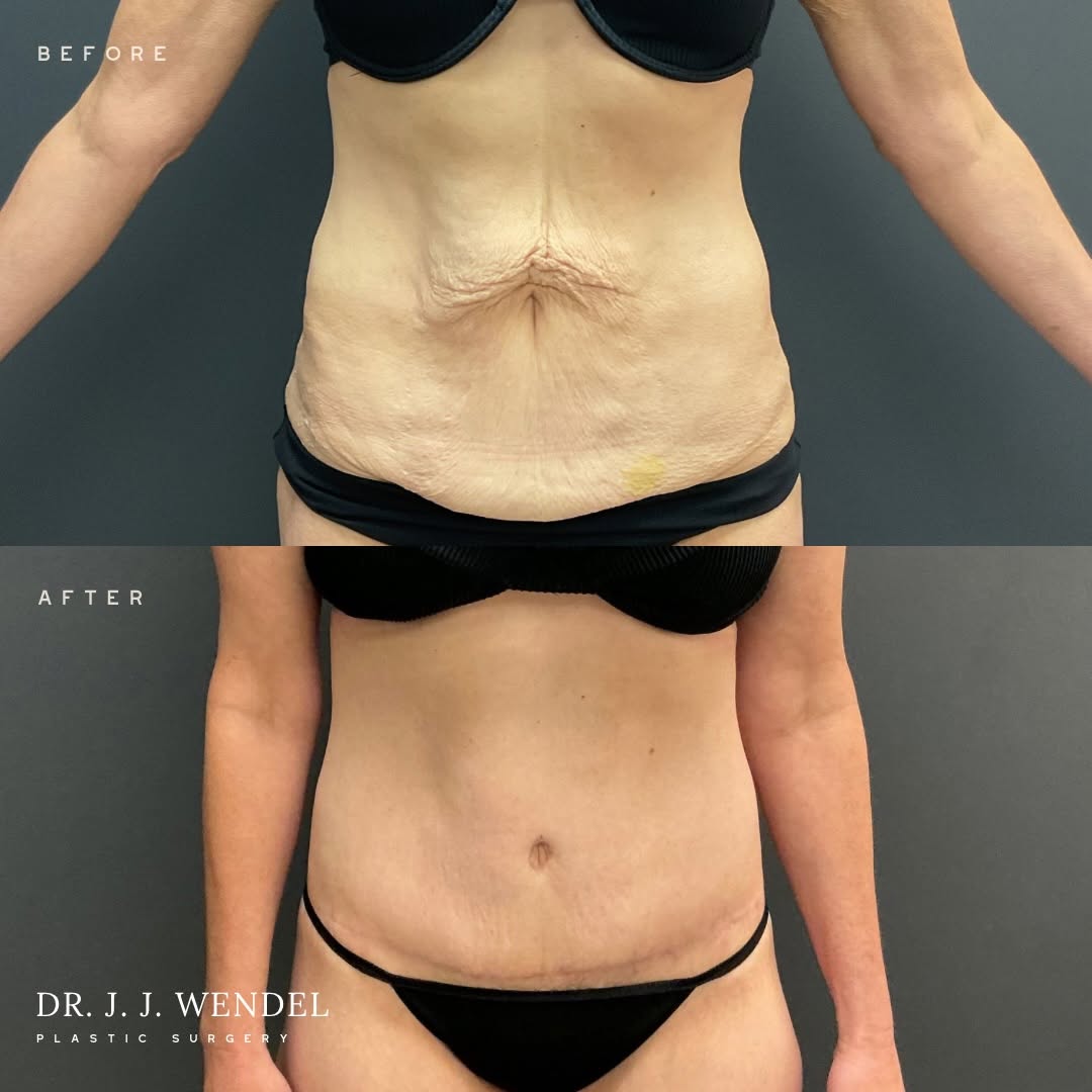 Instagram post by Dr. J. Jason Wendel: A flatter, firmer abdomen is about more than removing excess skin—it’s about restoring confidence. This patient underwent an abdominoplasty …