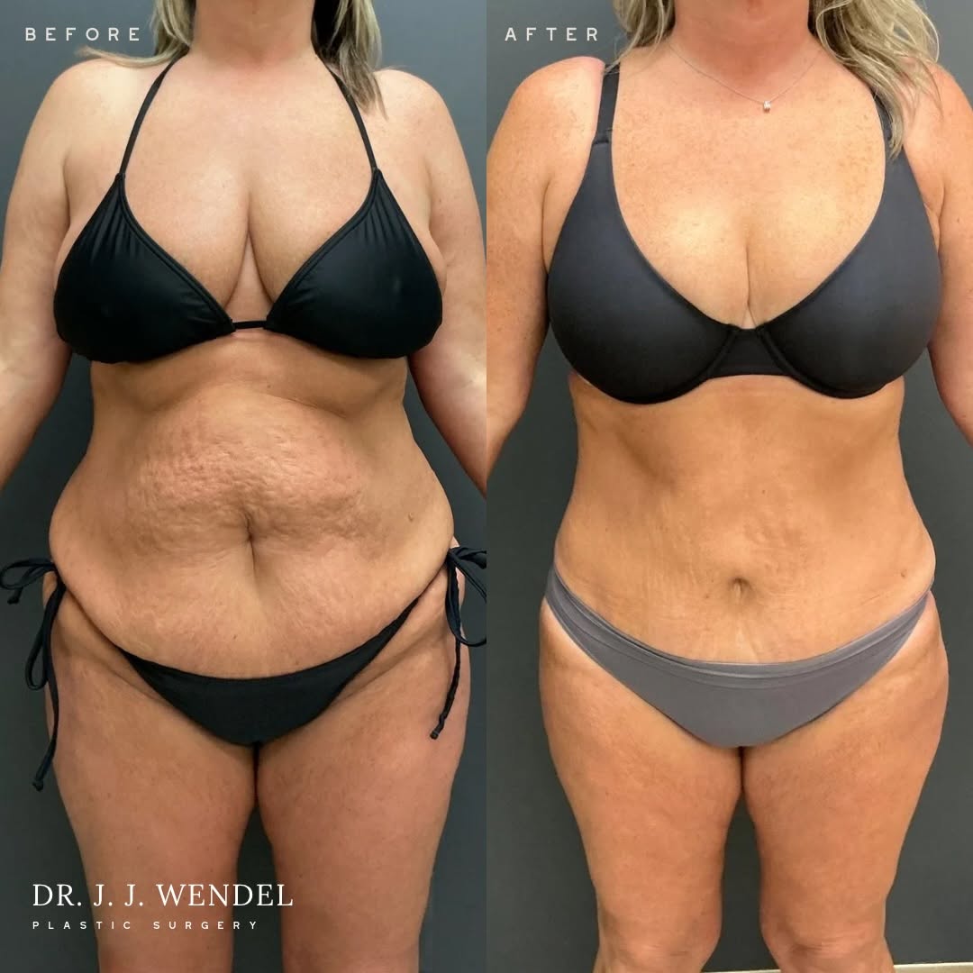 Instagram post by Dr. J. Jason Wendel: Three procedures, one thoughtfully designed surgical plan. For this patient, Dr. Jason Wendel combined an abdominoplasty (tummy tuck), masto…
