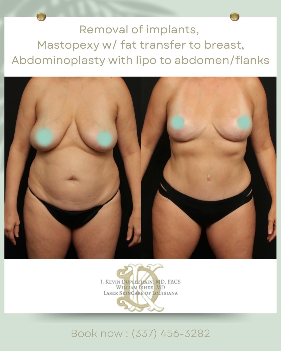 Instagram post by Dr. J. Kevin Duplechain: One surgery. A lot of change. ✨ For this patient, we combined: • Implant removal • Mastopexy (breast lift) + fat transfer to the breasts • A…