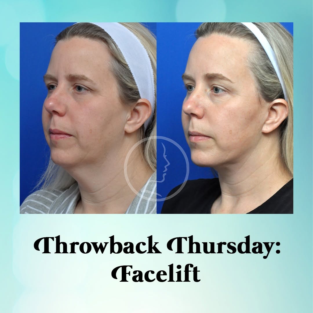 Instagram post by Dr. J. Phillip Garcia: Throwback Thursday to a facelift result that proves natural-looking refinement can make a beautiful difference ✨ This facelift patient also …