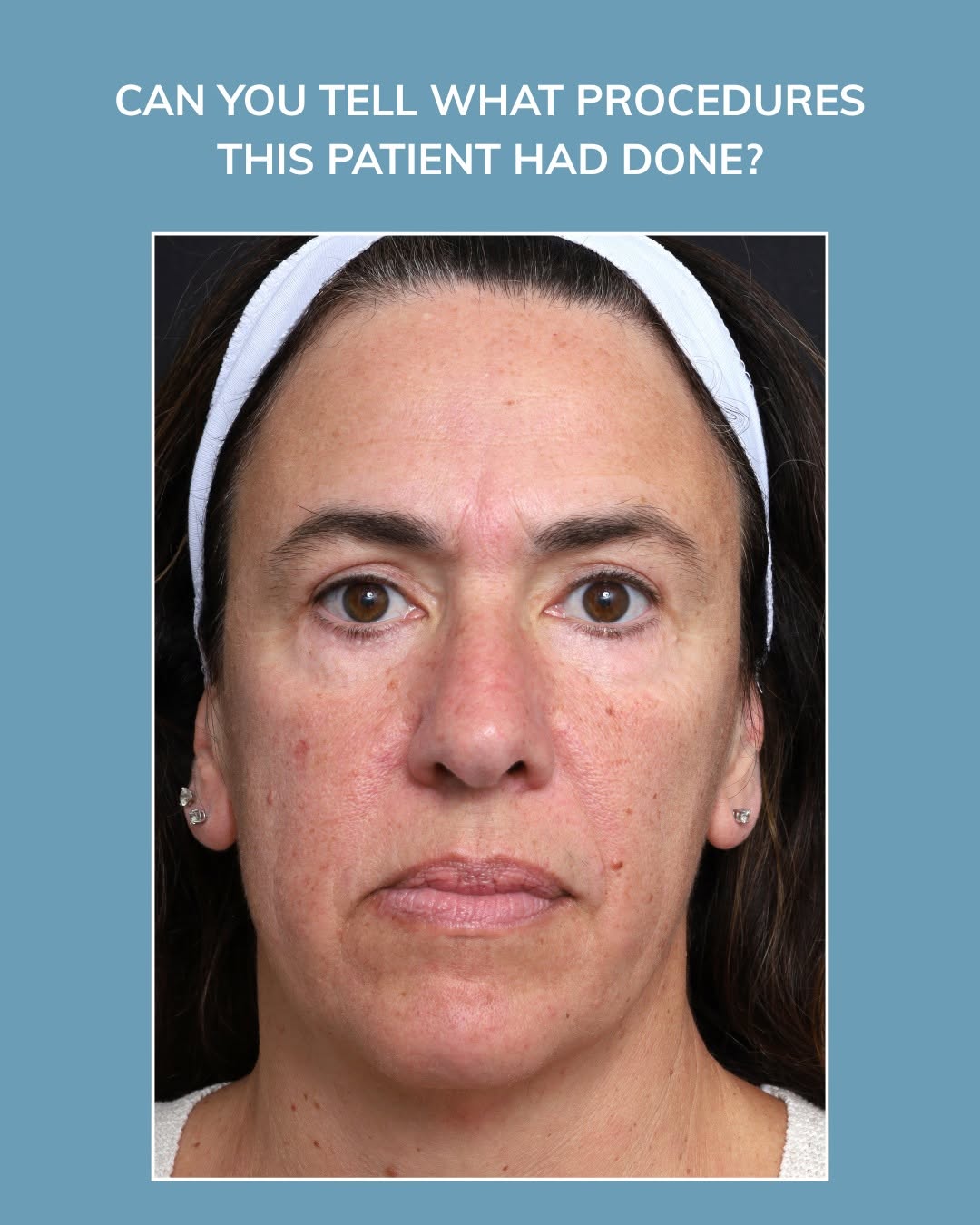 Instagram post by Dr. J. Phillip Garcia: Upper and lower blepharoplasty can refresh tired-looking eyes while keeping your appearance natural and unmistakably you 👁️✨ This patient u…