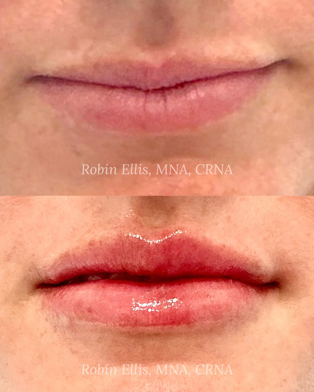 Instagram post by Dr. J. Randall Jordan: Pucker up for Mistletoe! 💋✨ Are soft, subtle, natural-looking lips on your Mistletoe Gala checklist? Now is the time to plan your perfect p…