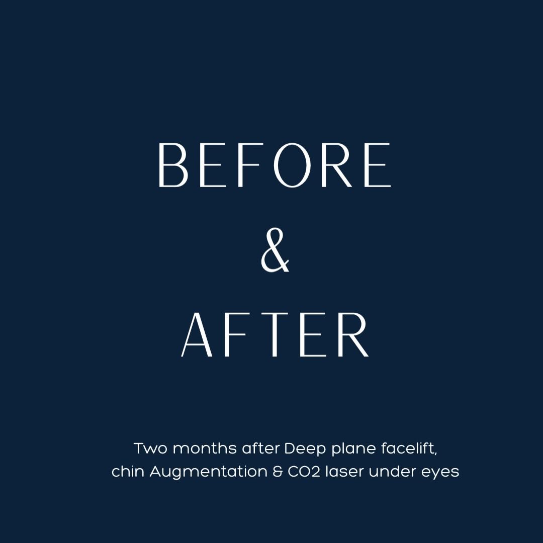 Instagram post by Dr. J. Smythe Rich: 🔹Just 2 months post-op, this beautiful result showcases the power of combining procedures for comprehensive facial rejuvenation: • Deep Pla…