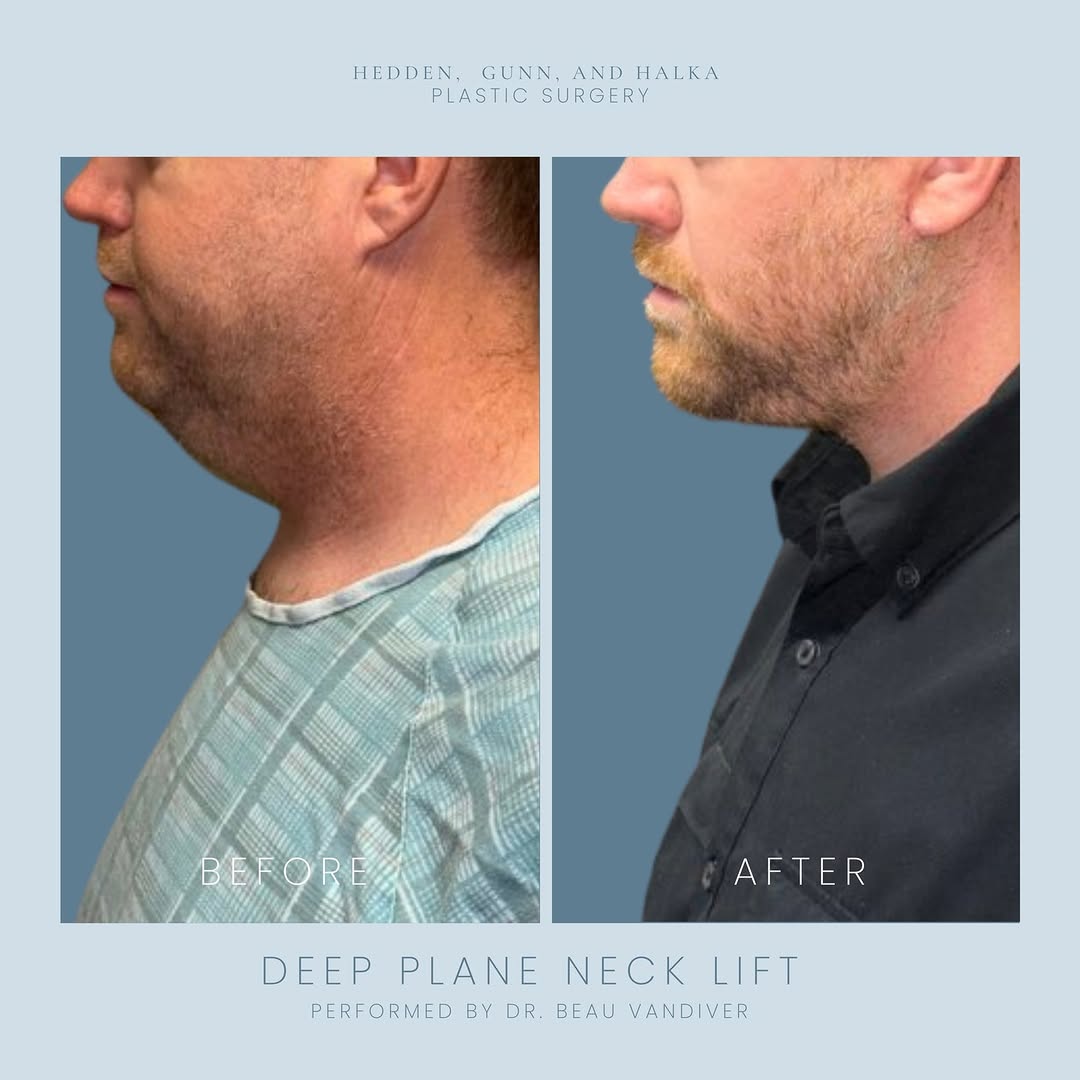 Instagram post by Dr. J. Stephen Gunn: Procedure Performed: Deep Plane Neck Lift Patients Goals: This patient desired a more defined jawline and neck contour, with improvement in …