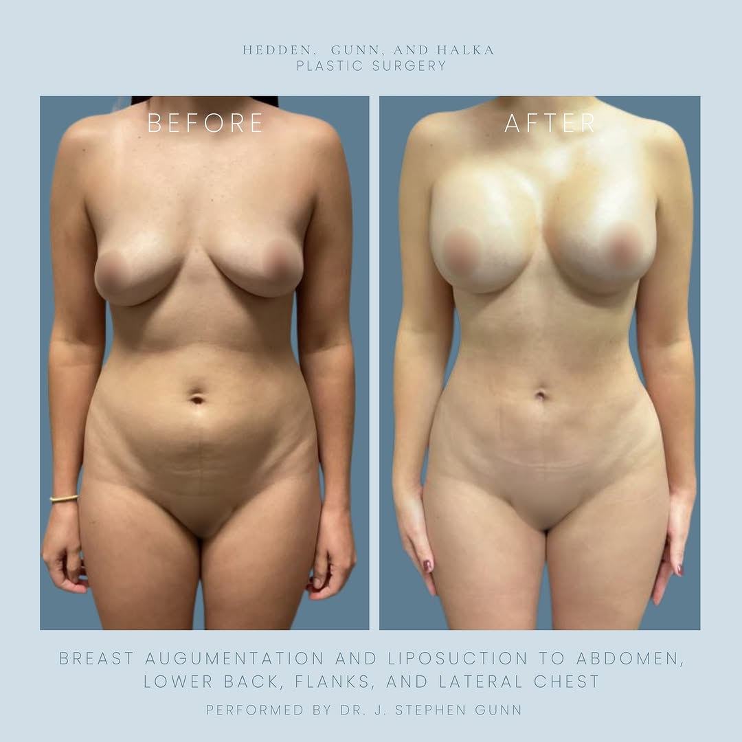 Instagram post by Dr. J. Stephen Gunn: Procedure Performed: Silicone Breast Augmentation and Liposuction to the abdomen, lower back, flanks, and lateral chest Patients Goals: Pati…
