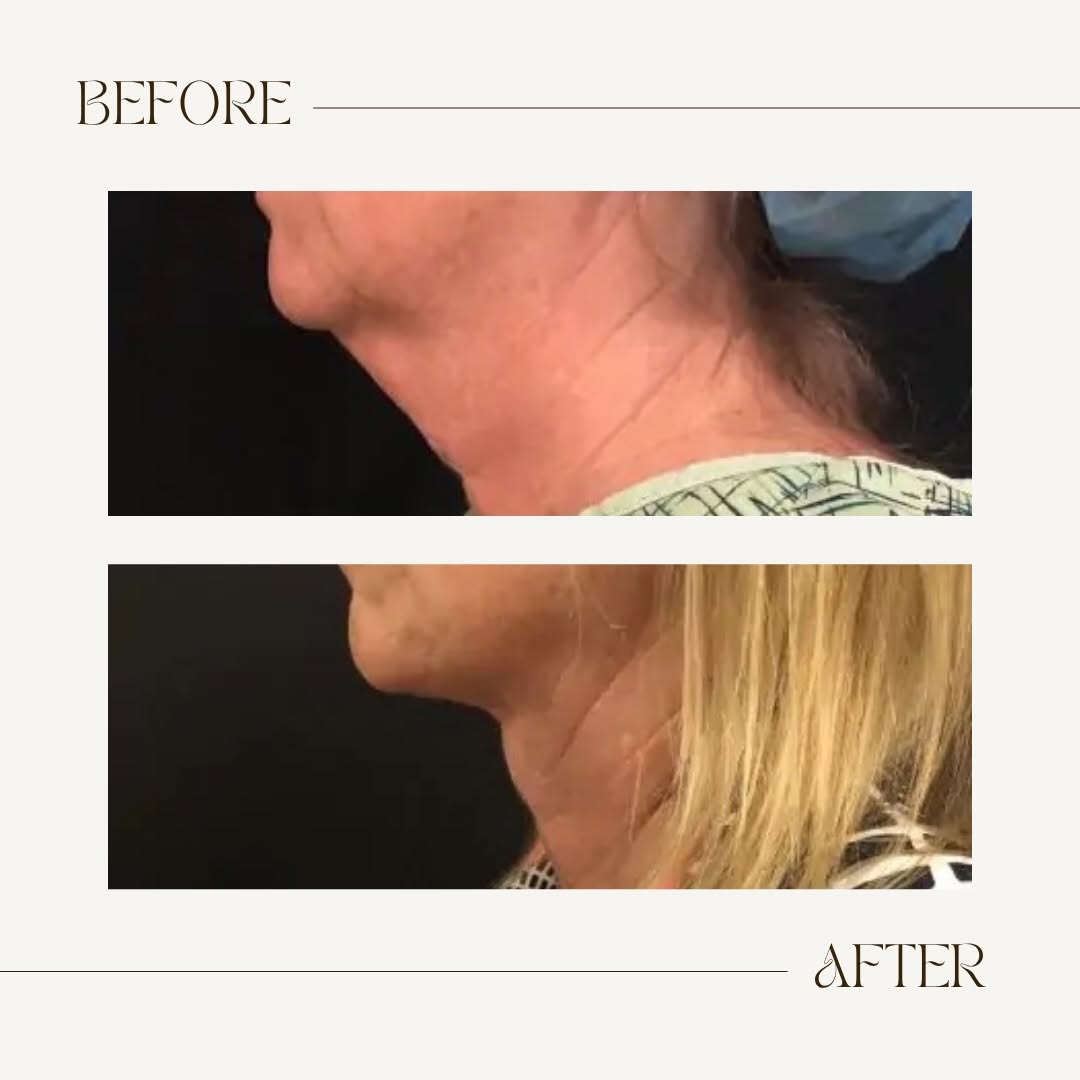 Instagram post by Dr. Jack Friedlander: A smoother neck. A more defined profile. ✨ Ready to see what Renuvion® can do for you? Book your consultation today! 🤍 #norcalliposculpture…