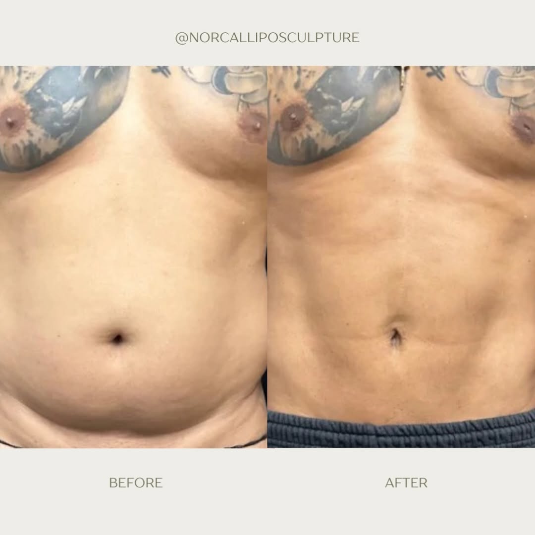Instagram post by Dr. Jack Friedlander: Swipe to see this 6-month VASER Lipo transformation. ✨ Call today to schedule your consultation. Let’s do it! #vaserlipo #norcalliposculptur…