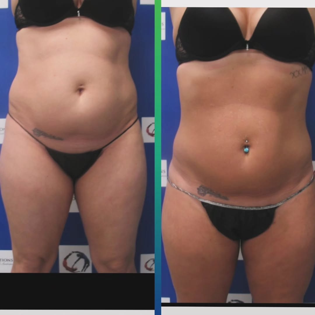 Instagram post by Dr. Jack G. Bertolino: It is NOT about weight loss!!! It is ALL about shape. Vaser-Microaire combination liposculpture look outstanding by next summer. Sexy by Chr…