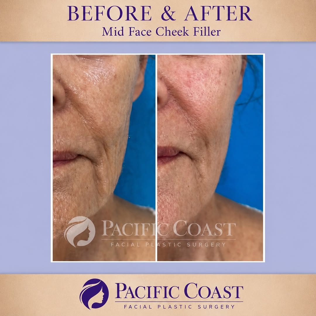Instagram post by Dr. Jacob Boeckmann: ✨ Mid-face & cheek fillers by Nurse Jessica! Mid-face and cheek filler can restore lost volume and create a subtle lift through the cheeks, …
