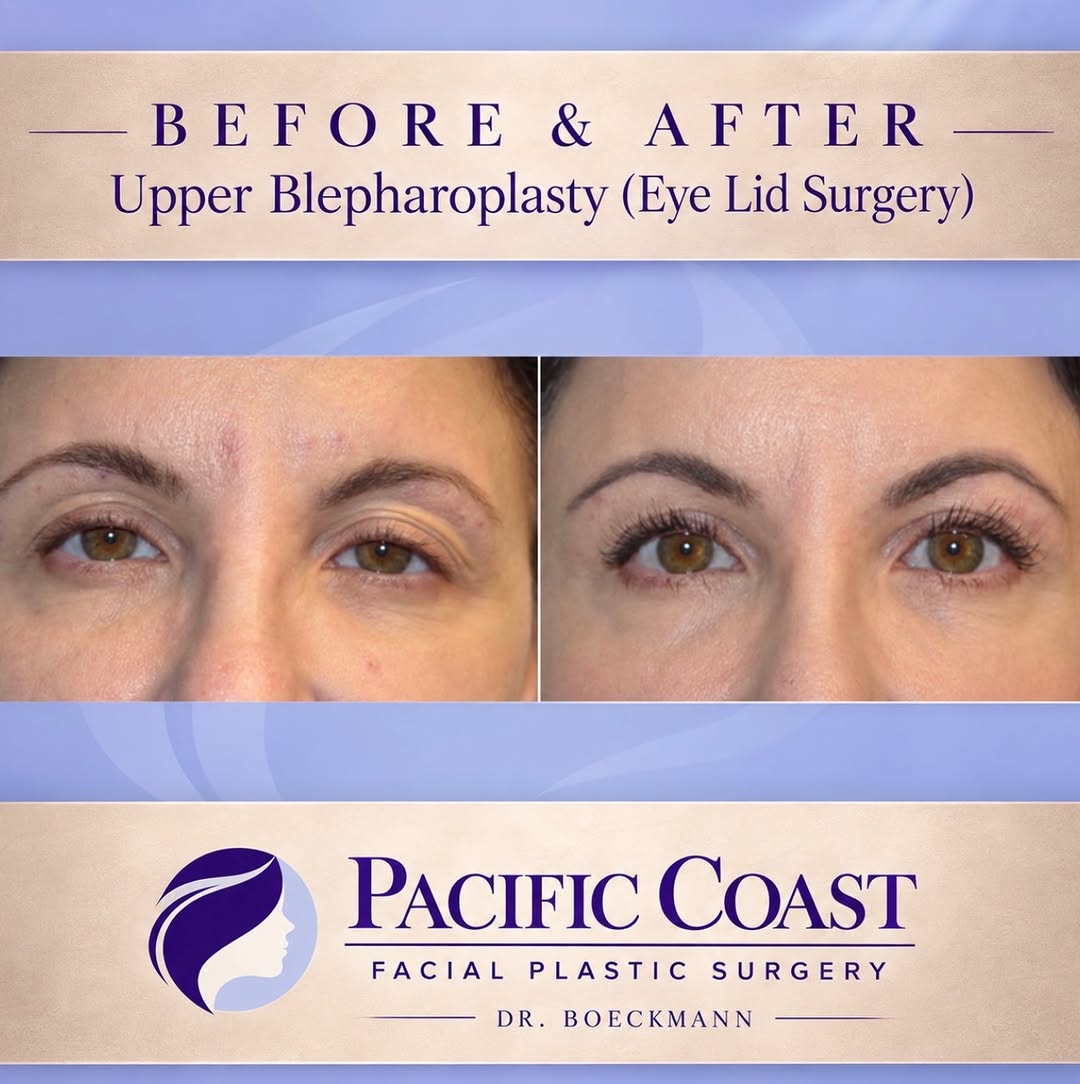 Instagram post by Dr. Jacob Boeckmann: Before & after of an upper blepharoplasty ⚡️ A refined, subtle procedure that can create such a beautiful, refreshed result—while maintainin…