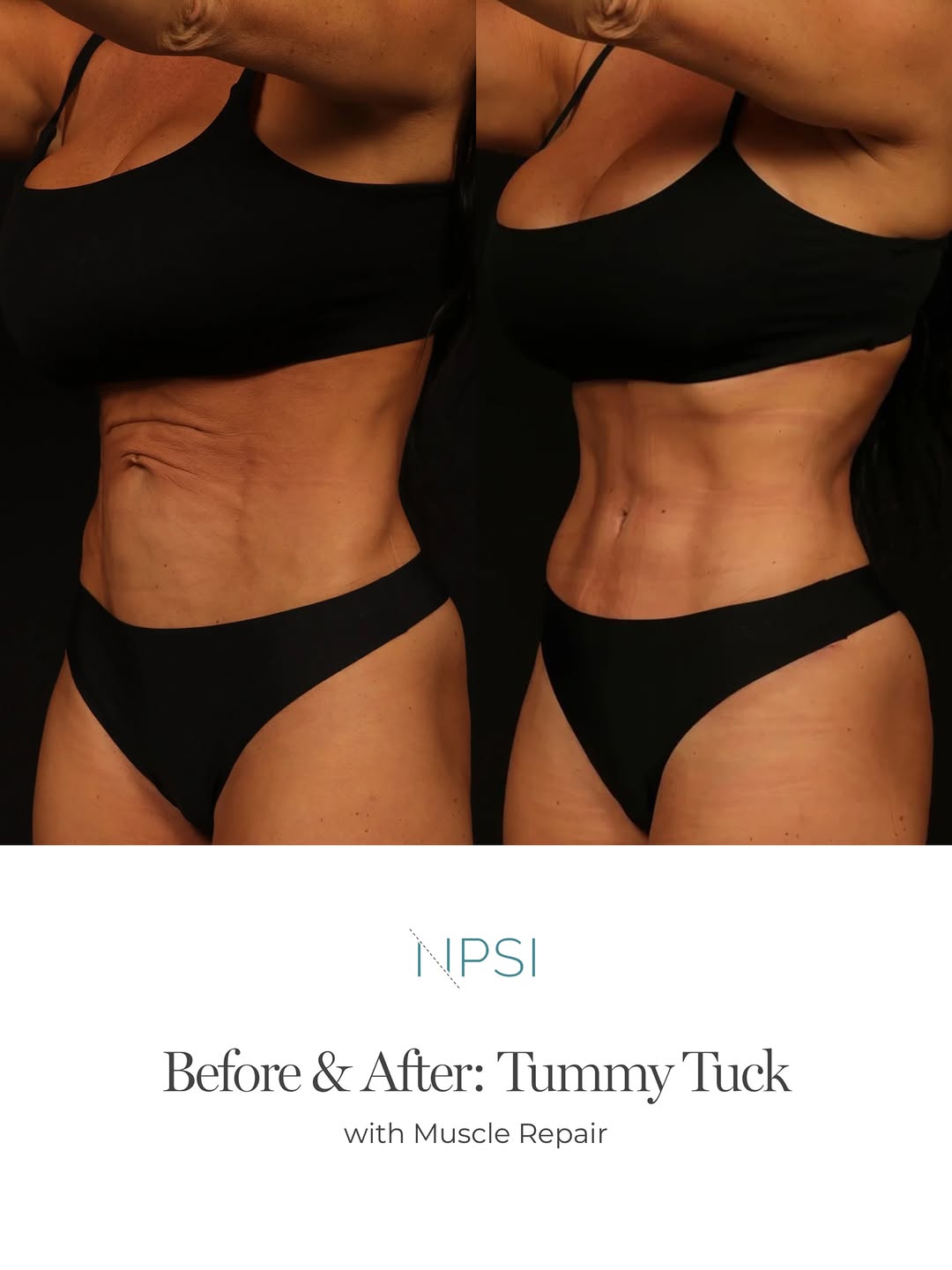 Instagram post by Dr. Jacob G. Unger: Some things can’t be worked away, no matter how consistent you are in the gym... Stretched or loose abdominal skin can remain even when you’…