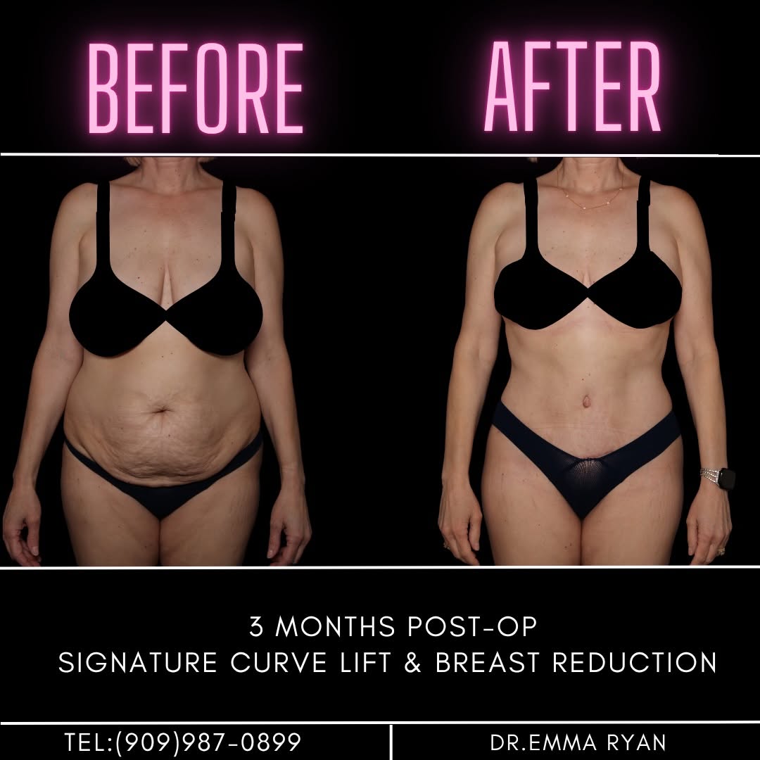 Instagram post by Dr. Jacob Haiavy: ✨ 3 MONTHS POST-OP ✨ A beautiful transformation by Dr. Ryan featuring our signature Curve Lift + Breast Reduction. The Signature Curve Lift …