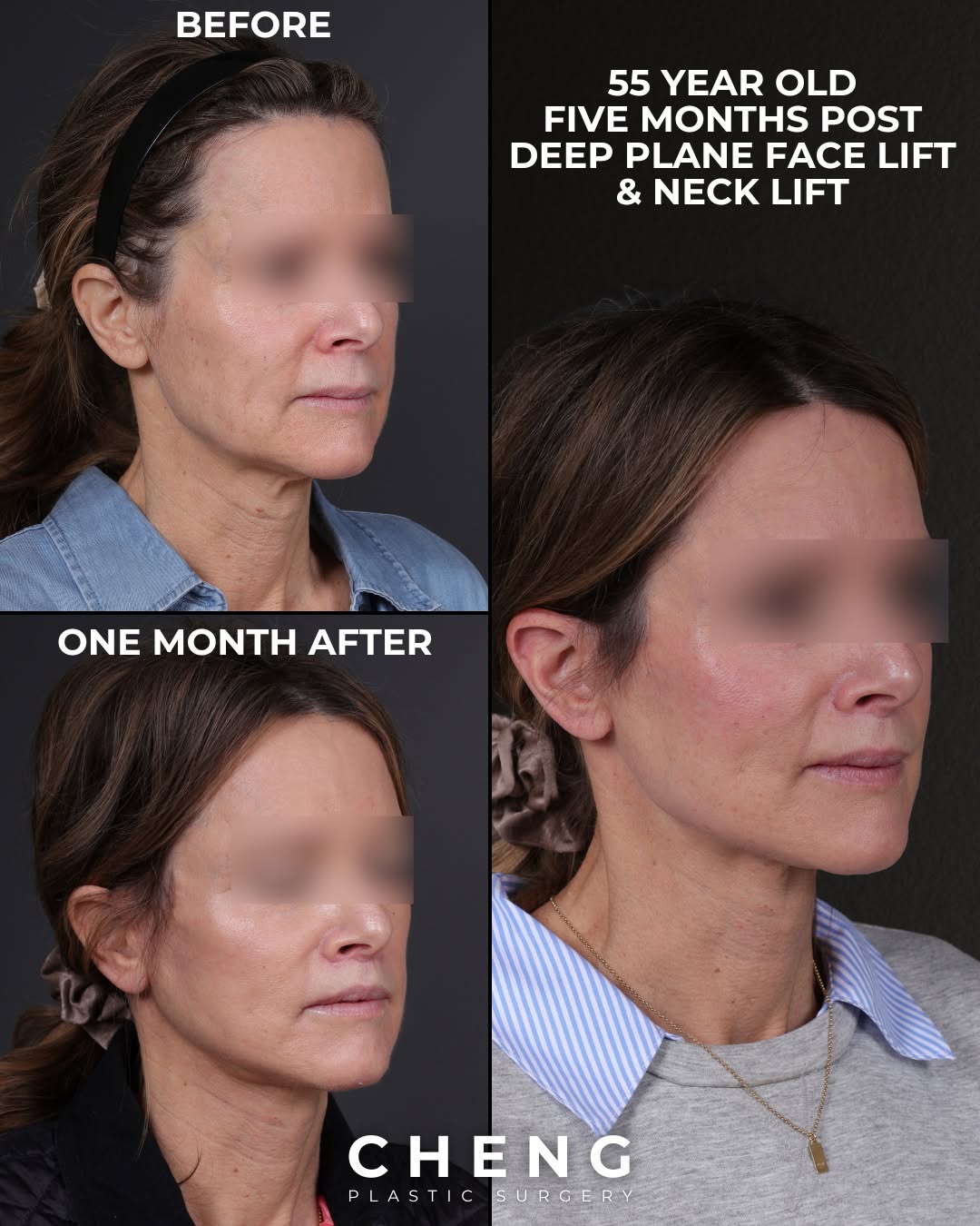 Instagram post by Dr. Jacqueline T. Cheng: At 5 months post-op, this patient’s results continue to evolve beautifully. She originally came to us concerned about jowling and laxity …