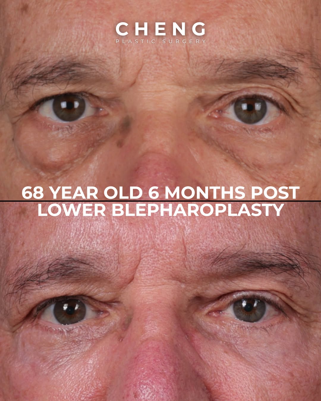 Instagram post by Dr. Jacqueline T. Cheng: This patient came to us wanting to improve the prominent under-eye bags that were making his eyes look heavier and more tired. Dr. Elbert Ch…