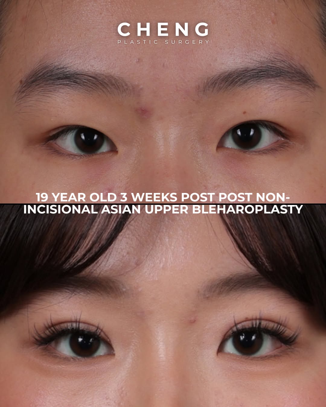 Instagram post by Dr. Jacqueline T. Cheng: Can Non-Incisional Asian Upper Blepharoplasty create a natural-looking eyelid crease without an external incision? For the right candidat…