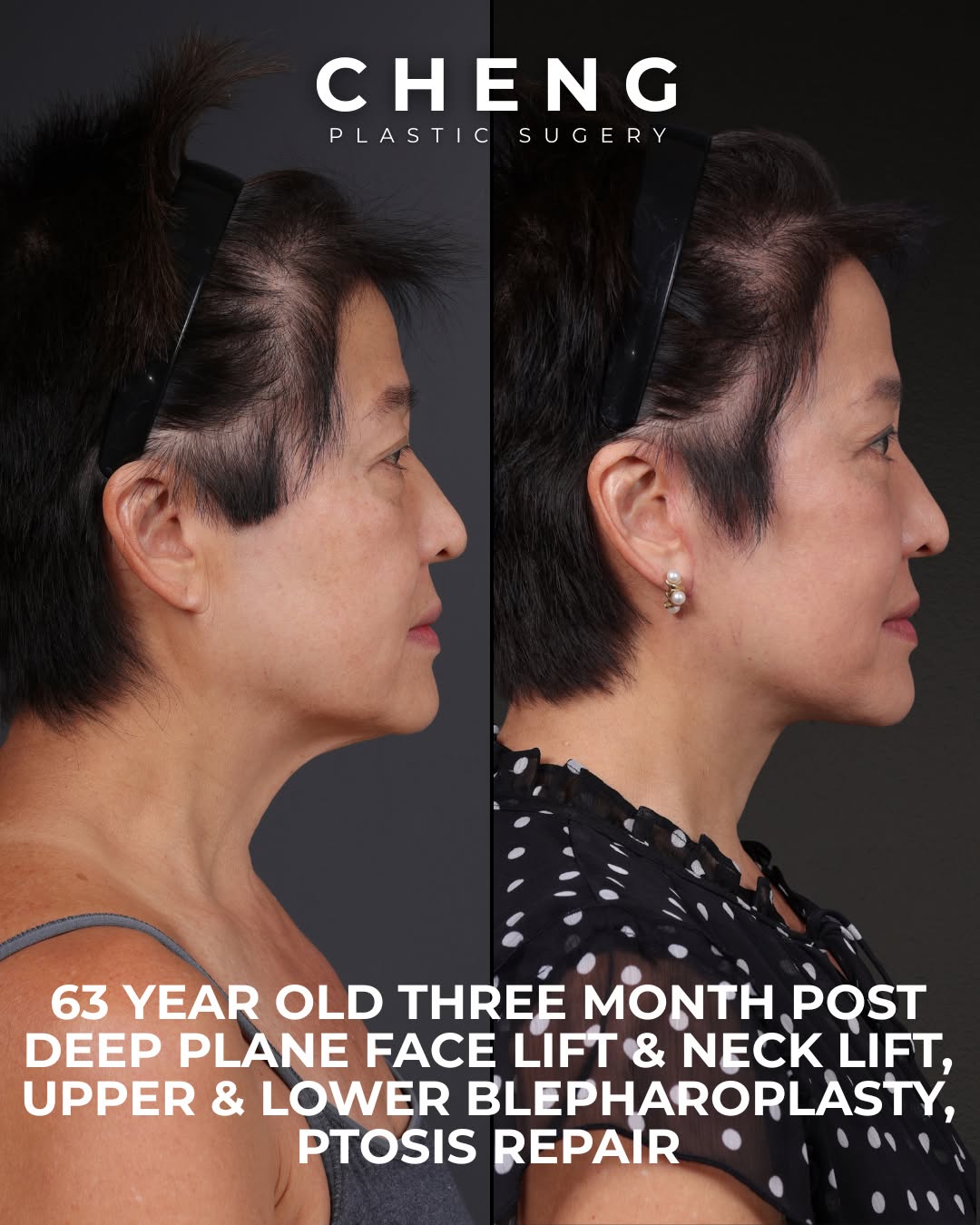Instagram post by Dr. Jacqueline T. Cheng: Can a facelift make you look refreshed without making you look “done”? That was the goal for this patient. She came to Dr. Elbert Cheng c…