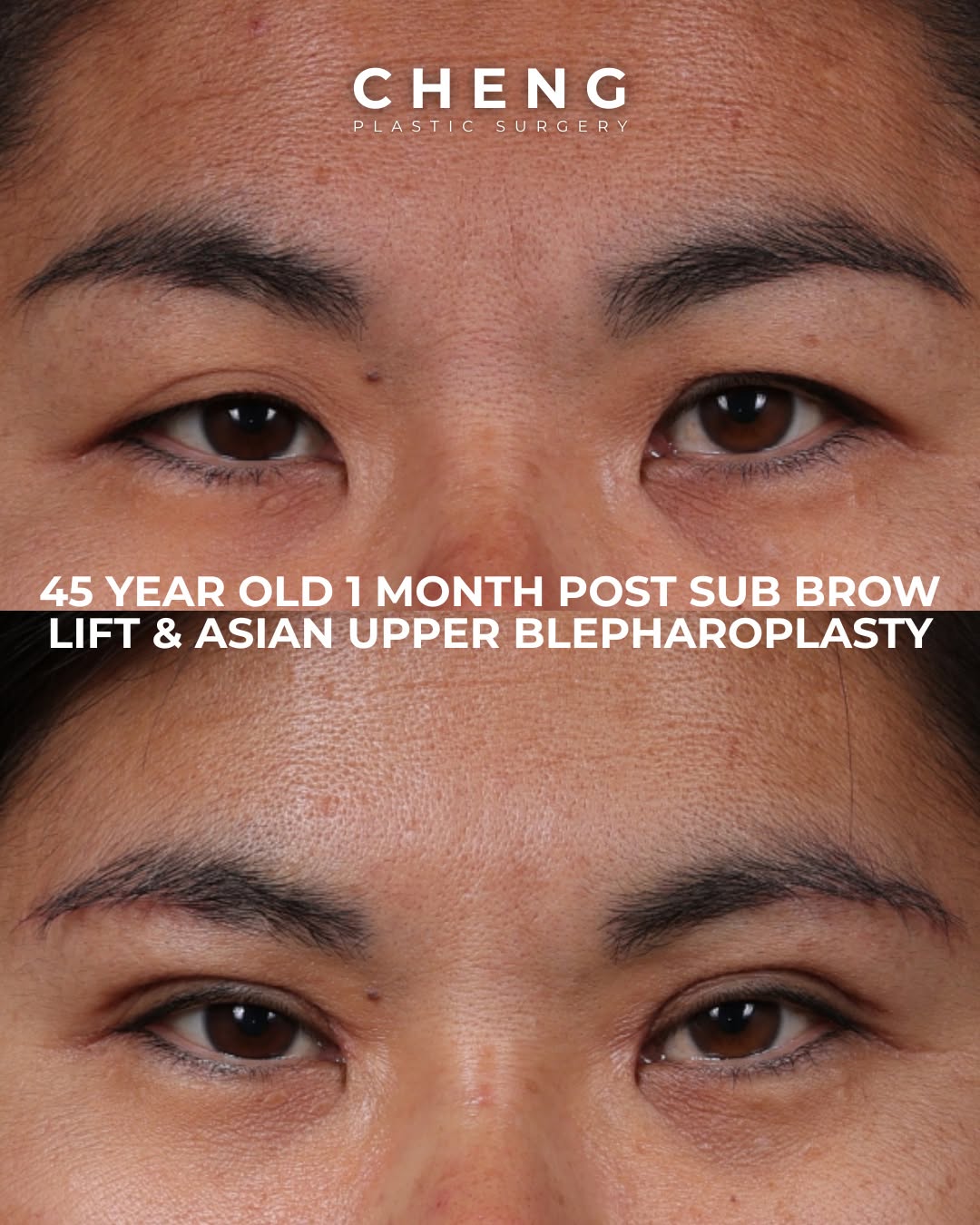 Instagram post by Dr. Jacqueline T. Cheng: How can I fix eyelid asymmetry? Eyelid asymmetry can come from differences in the eyelid crease, skin position, brow position, or underl…