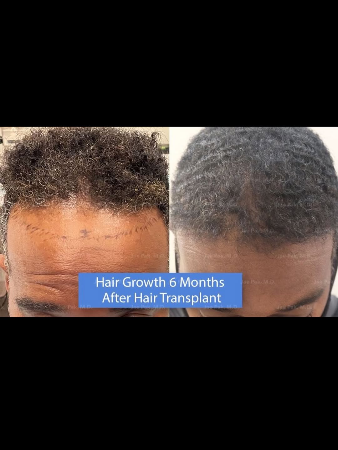 Instagram post by Dr. Jae Pak: Natural results start with a plan that’s built around you. From the hairline to overall density, every detail matters when restoring your ha…