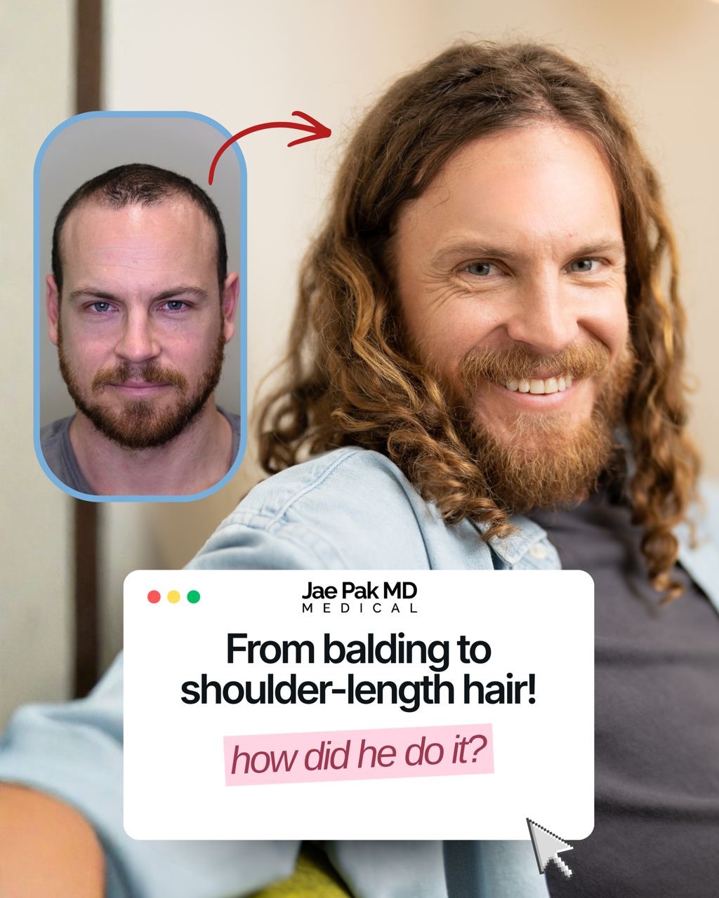 Instagram post by Dr. Jae Pak: A hair transplant can make a major difference when thinning starts to change the way your hairline looks. During the procedure, Dr. Jae Pak …