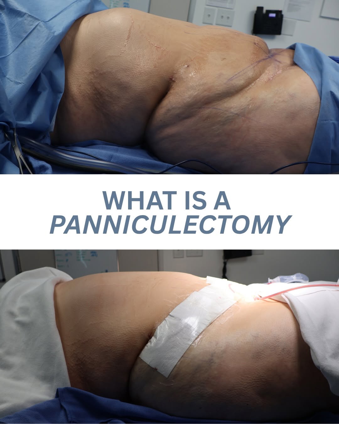 Instagram post by Dr. Jaime S. Schwartz: For patients who have experienced major weight loss, bariatric surgery, or pregnancy, excess skin around the abdomen can be one of the most …