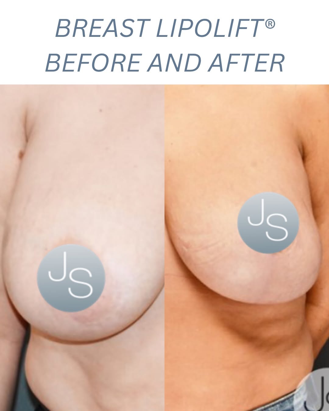 Instagram post by Dr. Jaime S. Schwartz: Not all breast procedures are created equal.👀 Breast LipoLift® was designed to sculpt the breasts using liposuction. Dr. Schwartz selective…