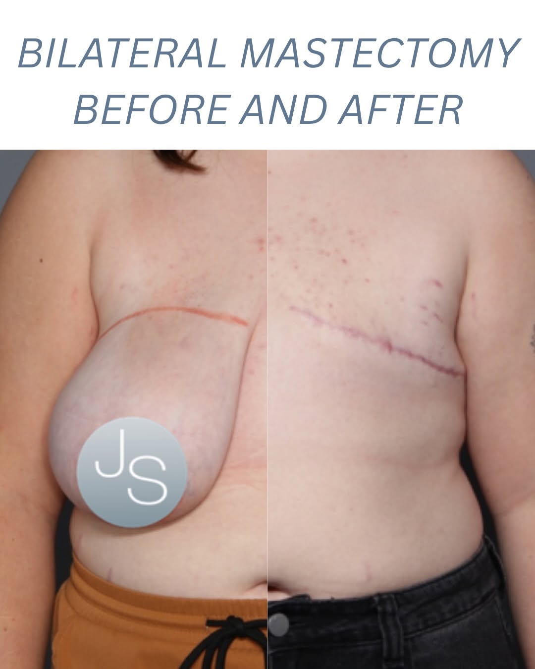 Instagram post by Dr. Jaime S. Schwartz: 3 months post op and already looking incredible.🤩 This patient is just beginning their healing journey following bilateral mastectomy recon…