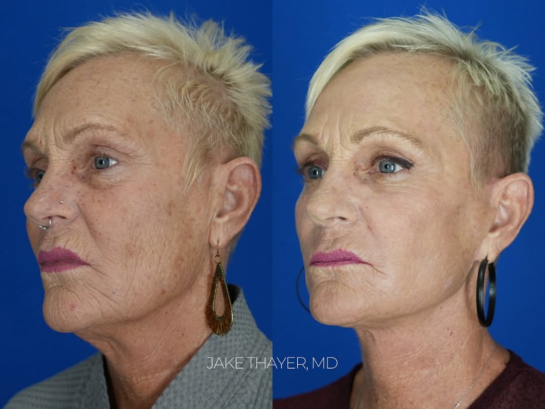 Instagram post by Dr. Jake Thayer: Contours improved and lines are softened! This patient underwent comprehensive facial rejuvenation, which included: - deep plane face and ne…