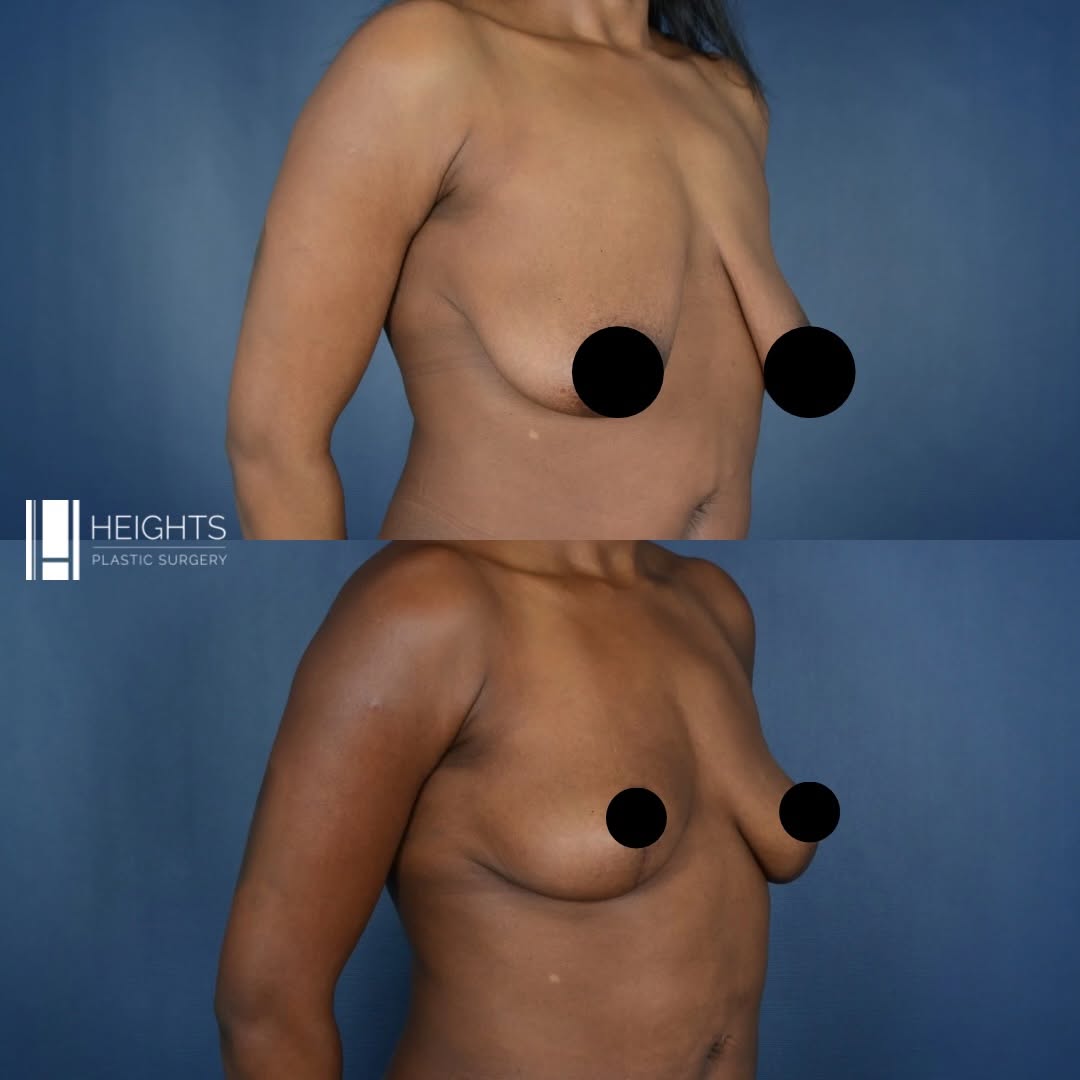Instagram post by Dr. Jamal Morrisette Bullocks: Transformation Tuesday! ⭐️ This patient underwent a bilateral mastopexy (breast lift) with fat grafting to the breast to restore youthful sh…