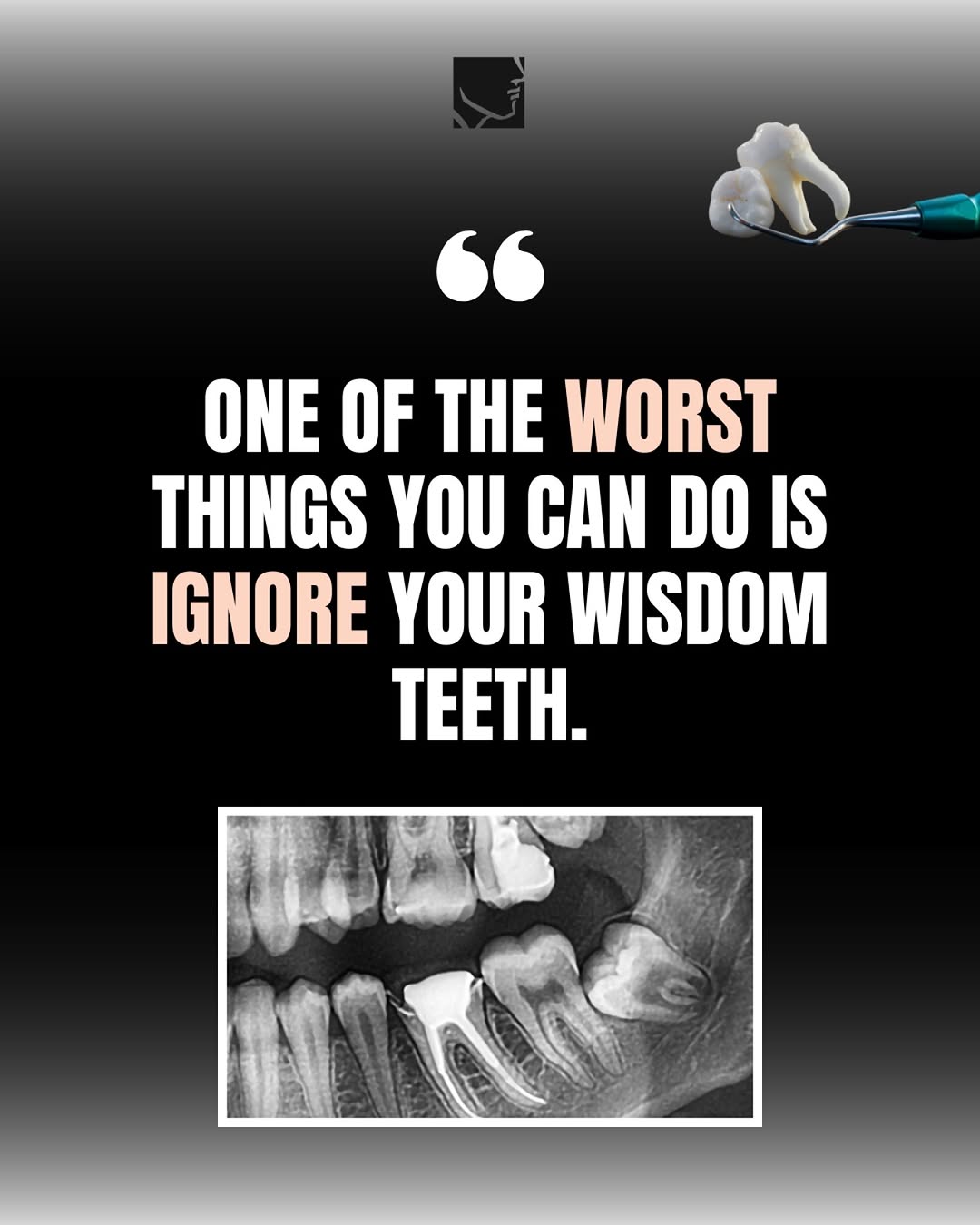 Instagram post by Dr. James A. Kraus, D: Don’t let your wisdom teeth woes sneak up on you! According to AAOMS, ignoring problematic wisdom teeth can lead to infections, severe pain,…